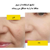 سرم پوست لانبنا مدل کوچک کننده منافذ حجم 15 میلی لیتر